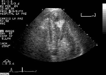 Ecocardiograma Contrastado