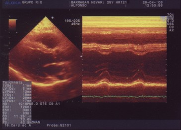 Ecocardiograma de estrés con Dipiridamol