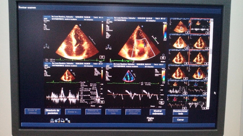 Electrocardiograma transtorácico